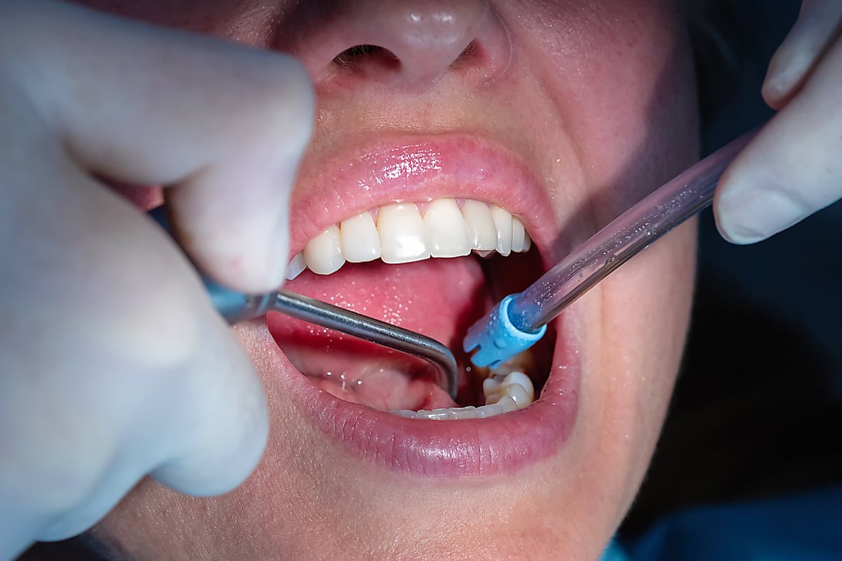 Dentist performing a tooth preparation procedure in a modern dental clinic